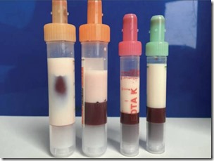 vials-of-thick-milky-blood
