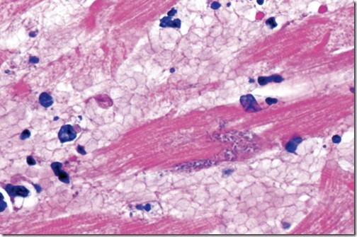 myocardium